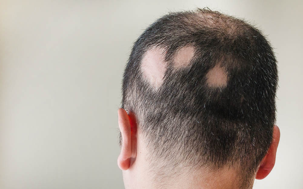 Patchy Hair Loss