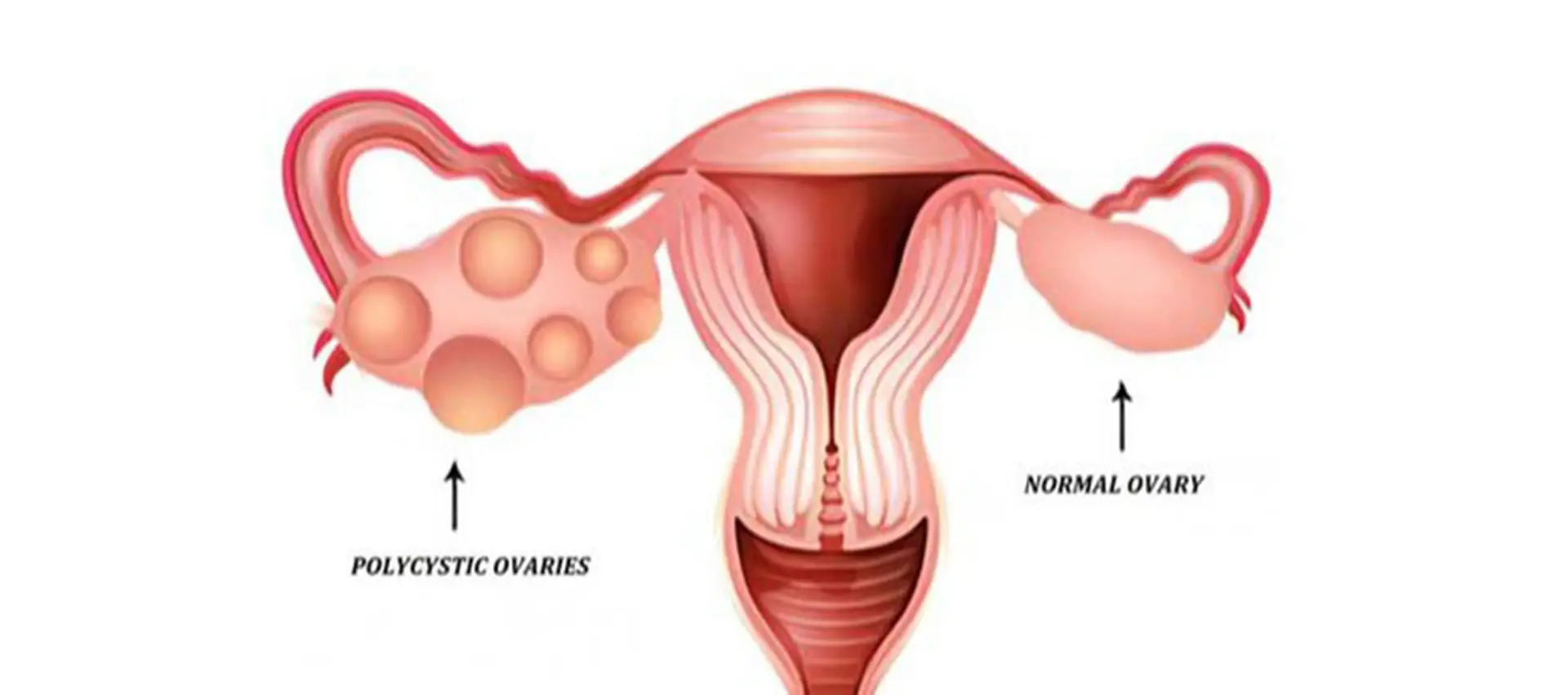 Women's Health Issues (PCOS/PCOD)