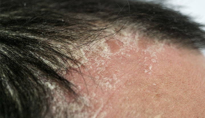 Psoriasis